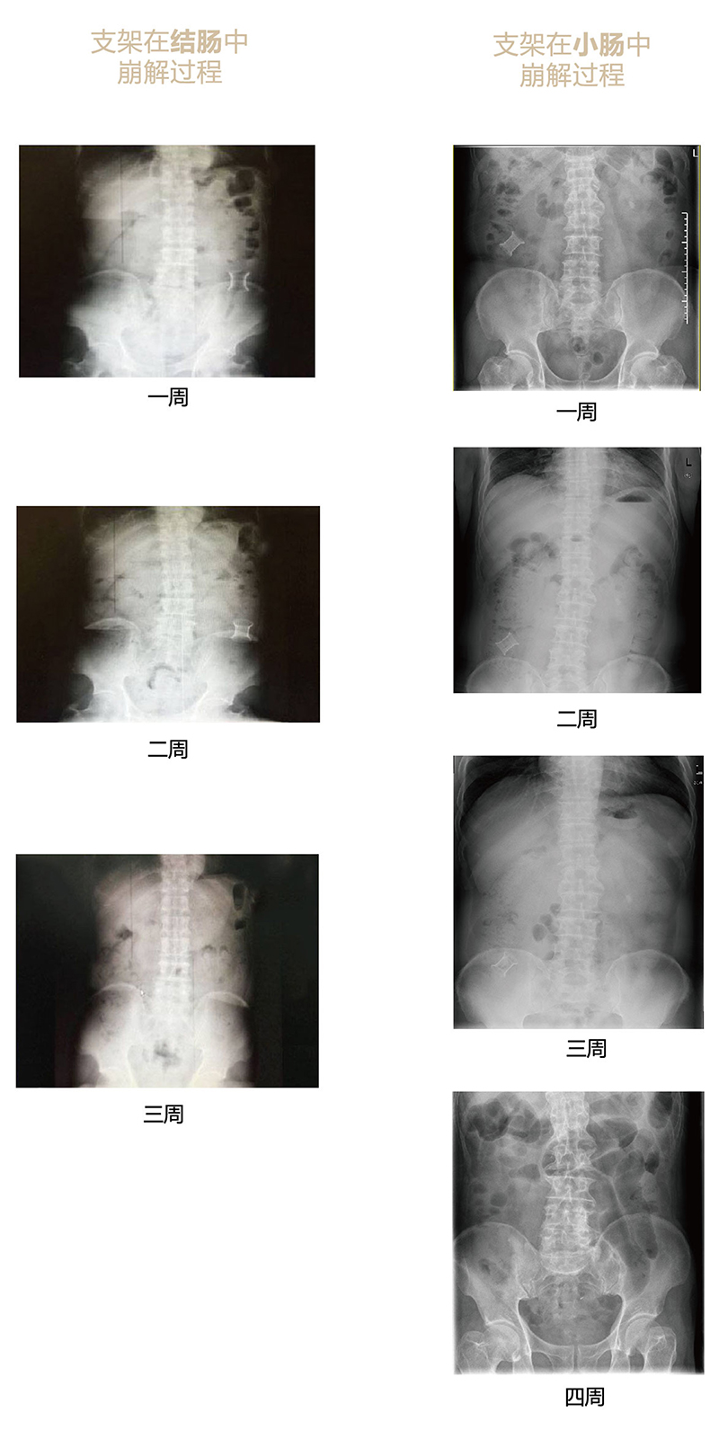 手術崩解過程x光片-01.jpg 手術崩解過程x光片-01.jpg